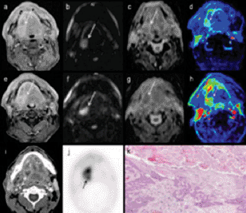 Imagen: RM multiparamétrica para la predicción temprana del tratamiento de la quimioradiación en el cáncer orofaríngeo: La fila superior es la RM pre-tratamiento de la base derecha del cáncer de lengua (a = T1 realzado por contraste como correlación anatómica; b = imagen de difusión-ponderada b1000 nativa; c = mapa-ADC; d = mapa-perfusión de IUAC). La fila media es a las dos semanas durante la quimioradiación: mismos conjuntos de imagenología, el volumen del tumor no ayudará. Sin cambio significativo en b1000, ADC ni RM de perfusión indican no respuesta y por lo tanto un riesgo alto de recaída del tumor después de terminar el tratamiento. Recaída del tumor en TEP-TC, ocho meses después de finalizar el tratamiento, demostrada por histología (k) (Fotografía cortesía del Prof. Vincent Vandecaveye, Hospital Universitario Lovaina, Bélgica).
